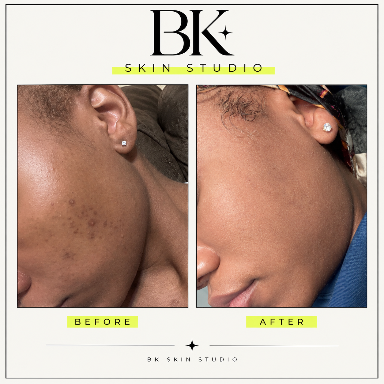BK Skin Studio before and after comparison of post inflammatory hyperpigmentation